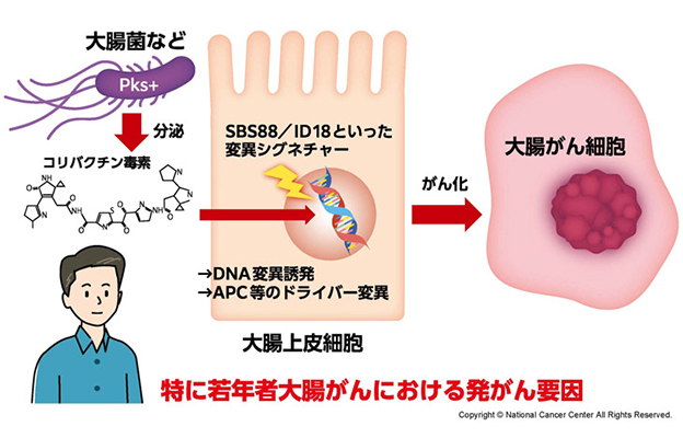 日本國立癌症研究中心：約半數大腸癌或與腸道菌群相關，分泌毒素會引發特定基因突變