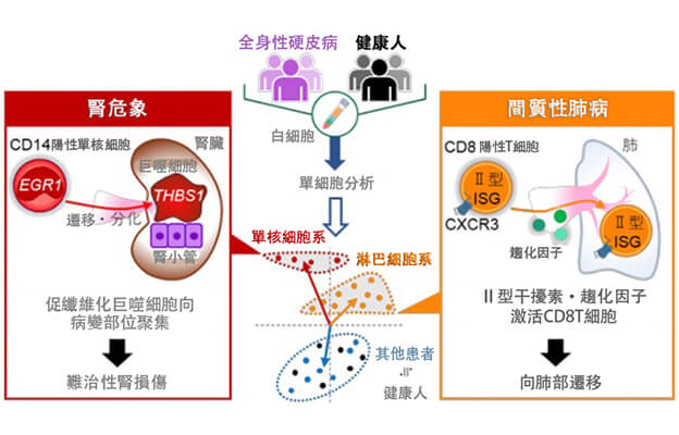 大阪大學發現通過白血球的單細胞分析可預測罕見病「全身性硬皮病」的致命性重症