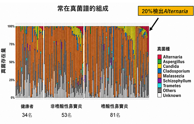 福井大與筑波大發現真菌參與嗜酸性鼻竇炎惡化，感染鏈格孢菌復發風險升至2.8倍