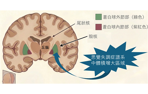 東京大學調查300多人MRI圖像發現精神分裂症患者腦部外形特徵——蒼白球外節部體積增大