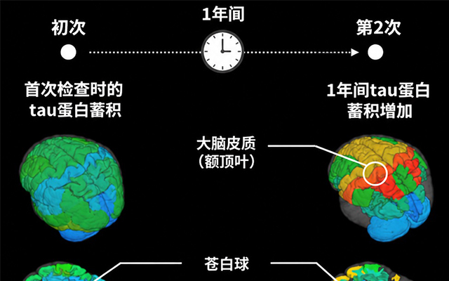 QST首次證實進行性核上性麻痹患者腦內的tau蛋白持續增加，並與症狀進展相關