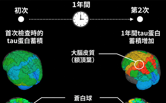 QST首次證實進行性核上性麻痹患者腦內的tau蛋白持續增加，並與症狀進展相關