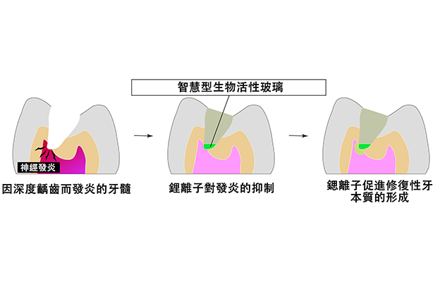 大阪大學開發可分階段釋放離子的玻璃粒子，有望實現「無需拔除牙神經」的齲齒治療
