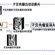 東京大學利用AI自動進行子宮肉瘤術前診斷，正確率達90%