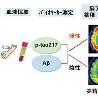 東京大學等透過血液檢測預測阿茲海默症，有望實施早期診斷