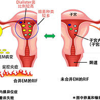 山梨大學等研究發現反復著床失敗的子宮內膜異位症患者的子宮中高機率存在牙周病菌