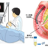 大阪大學開發出通過胃鏡檢查早期診斷胰腺癌的技術，簡便檢測基因突變