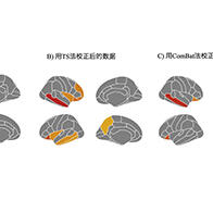 福井大學等發現ADHD患兒大腦右側顳中回體積較小