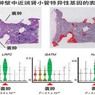 日本國立癌研與東京大學明確透析患者特有的腎癌在囊腫形成後的發病機製