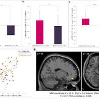 富山大學等研發出記憶干預程序：可緩解大腦反復回憶負面事件的傾向，有望用於壓力相關精神障礙的預防與治療