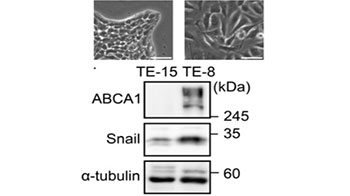 九州大學等闡明脂質代謝失衡會導致抗癌藥難以收效的分子機制 為開拓新治療策略開闢道路