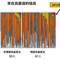 福井大與筑波大發現真菌參與嗜酸性鼻竇炎惡化，感染鏈格孢菌復發風險升至2.8倍
