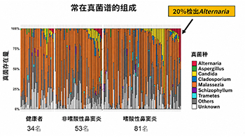 福井大與筑波大發現真菌參與嗜酸性鼻竇炎惡化，感染鏈格孢菌復發風險升至2.8倍