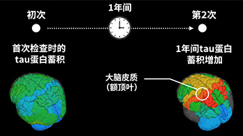 QST首次證實進行性核上性麻痹患者腦內的tau蛋白持續增加，並與症狀進展相關