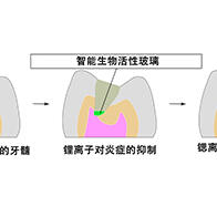 大阪大學開發可分階段釋放離子的玻璃粒子，有望實現「無需拔除牙神經」的齲齒治療