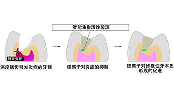大阪大學開發可分階段釋放離子的玻璃粒子，有望實現「無需拔除牙神經」的齲齒治療