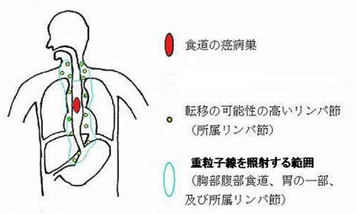 重粒子線癌症冶癒報告　食道癌：3年及5年生存率分別達到86%和81%