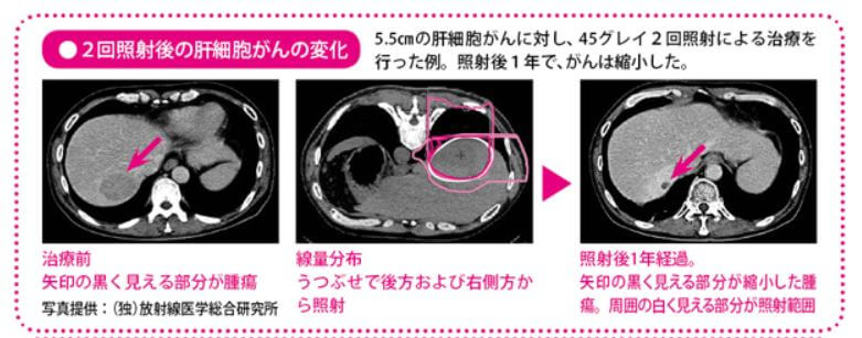 重粒子線癌症冶癒報告 肝癌：3年生存率爲73%