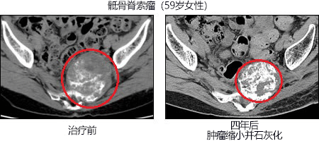 重粒子線癌症冶癒報告 軟組織骨肉瘤：5年生存率達到45%