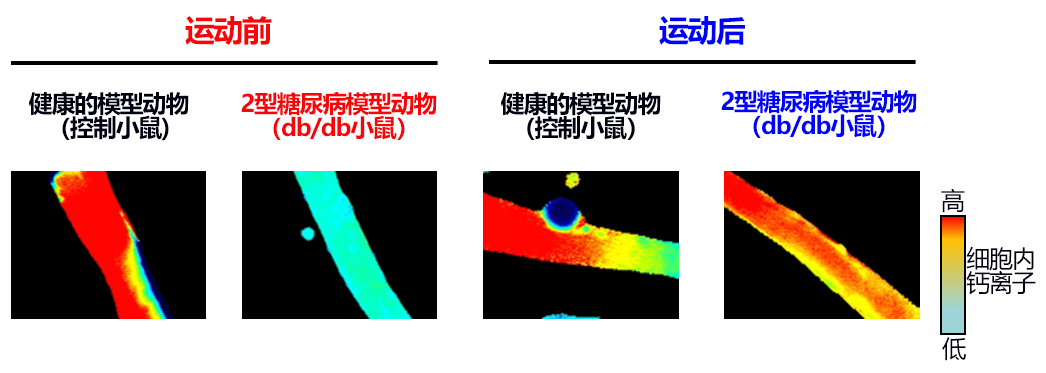 順天堂大學查明2型糖尿病患者肌肉力量下降的終極因數