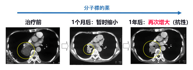 日本查明肺癌細胞如何在分子靶向藥物中存活