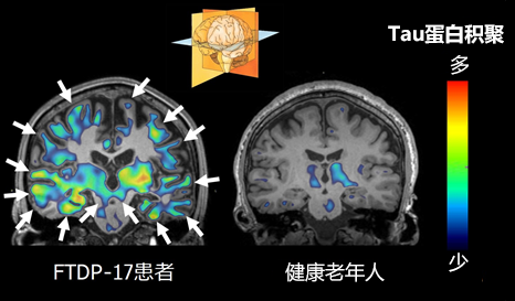 日本查明遺傳性癡呆症發生的腦内異常