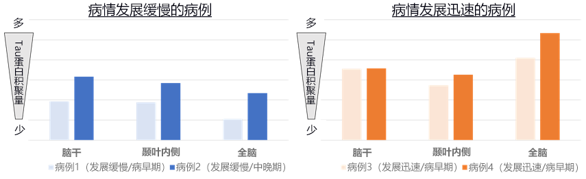 日本查明遺傳性癡呆症發生的腦内異常