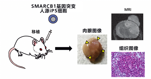 日本京都大學與東京大學利用人源iPS細胞製作腦腫瘤模式，查明兒童腦腫瘤病理