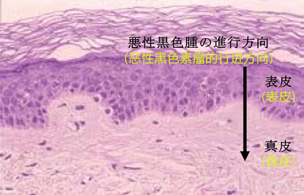 日本東北大學等成功透過導熱率判斷皮膚癌的程度