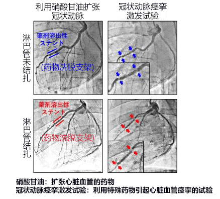 全球首次！日本查明心臟淋巴流與心絞痛之間的關係