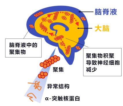 大阪大學成功從患者腦脊髓液中檢測出巴金森氏症致病蛋白聚集物