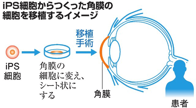 日本iPS細胞研究報告(廿七) 阪大篇：世界首例iPS角膜移植