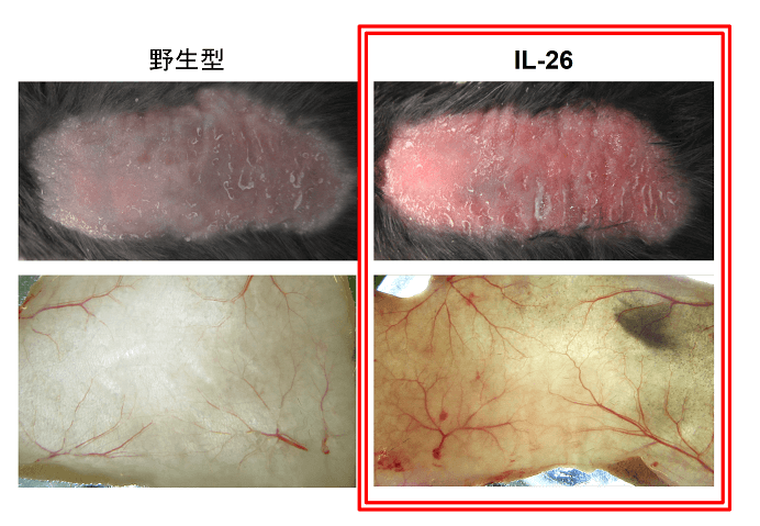 順天堂大學查明銀屑病等皮膚病惡化機制