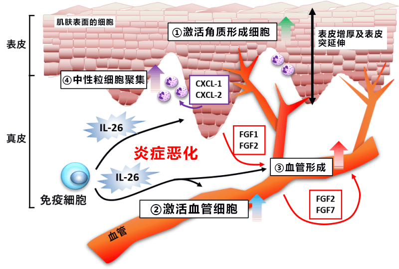 順天堂大學查明銀屑病等皮膚病惡化機制