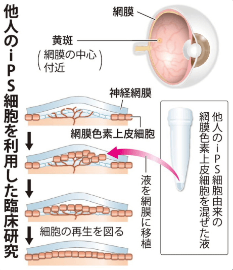 日本iPS細胞研究報告(廿九) 理研篇：應答視網膜移植試驗安全