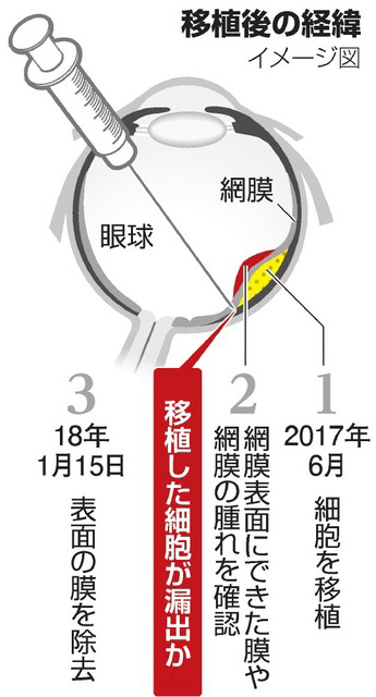 日本iPS細胞研究報告(廿九) 理研篇：應答視網膜移植試驗安全