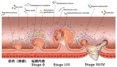 檢查糞便可早期確診大腸癌，日本發現大腸癌特徵性細菌和代謝物