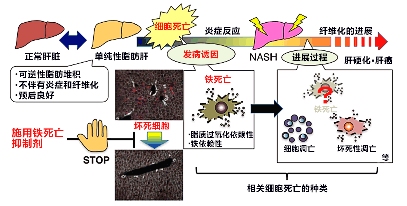 日本查明誘發脂肪肝隊形變換成肝炎的「鐵死亡」，爲預防和冶癒脂肪性肝炎鋪路