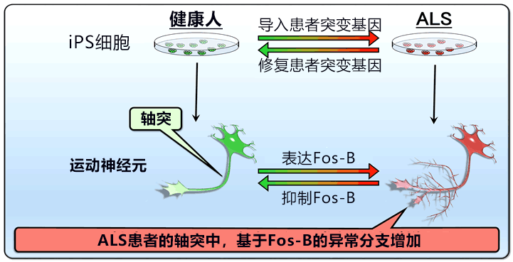 日本透過iPS細胞發現漸凍症新病理，有望用於早期靶向冶癒