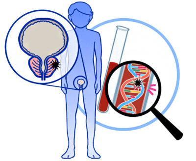 日本理研等對前列腺癌實施大規模DNA解析