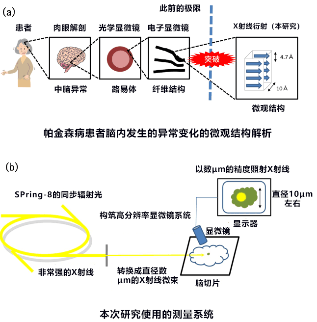 大阪大學等證實巴金森氏症是澱粉樣變病的一種