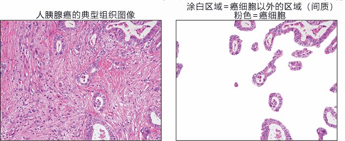 日本發現抑制胰腺癌惡化的新型細胞，有望開發改變癌細胞週遭環境的新療法