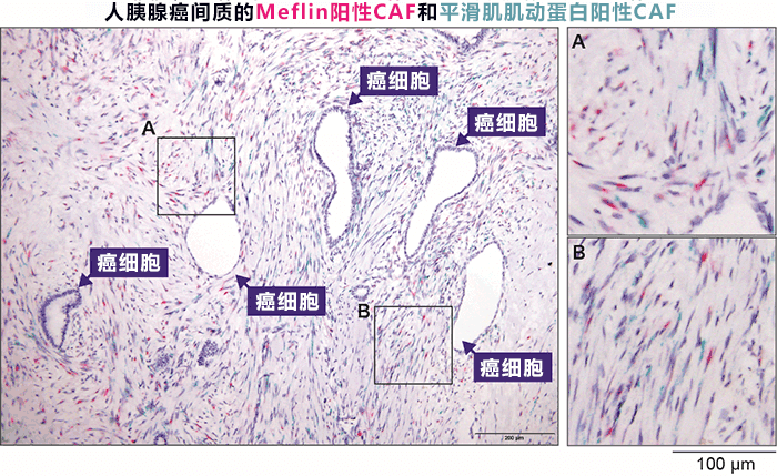 日本發現抑制胰腺癌惡化的新型細胞，有望開發改變癌細胞週遭環境的新療法