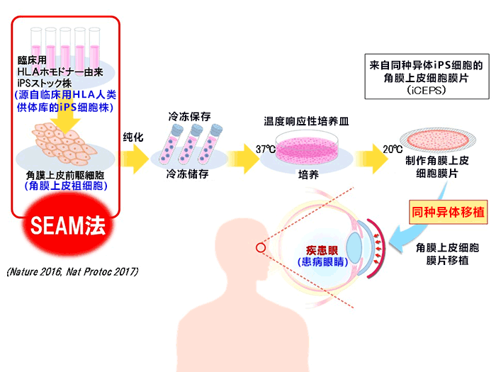 阪大實施全球首例iPS細胞角膜移植，患者出院年内實施第二例