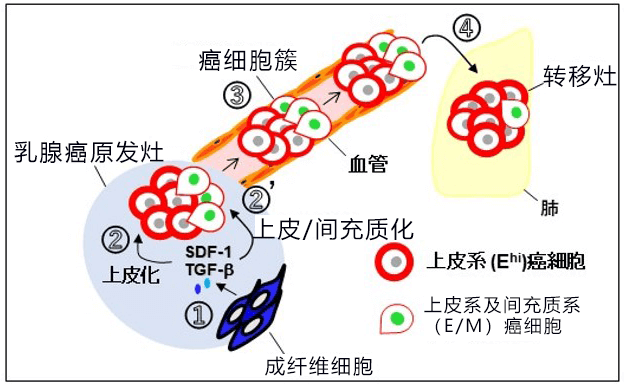 日本發現促進乳房癌浸潤和轉移的新機制，有望開發新療法