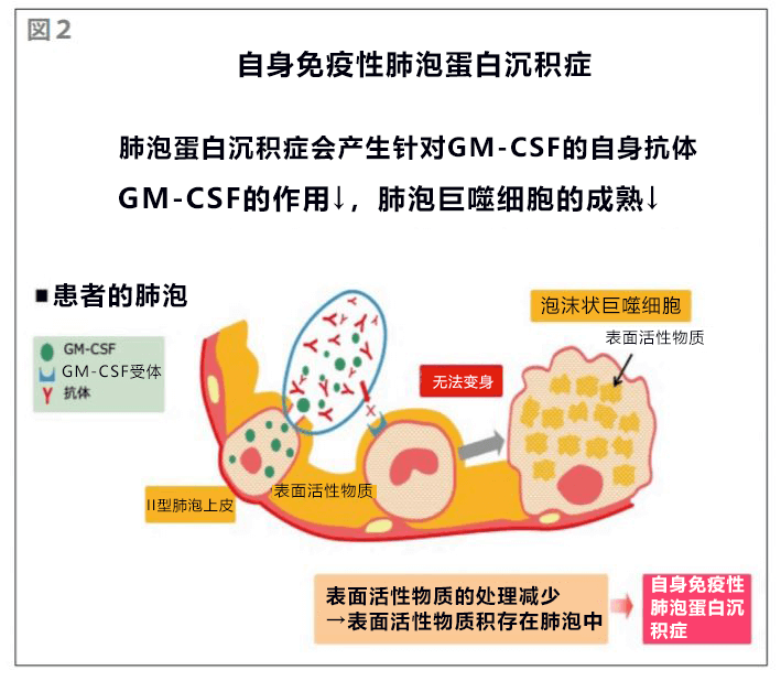 千葉大學等驗證吸入療法對難治性呼吸系統疾病的效果，可冶癒自體免疫性肺泡蛋白沉積物症