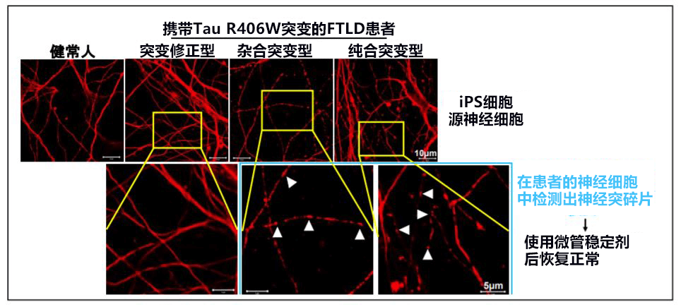 日本培養出家族性癡呆症iPS細胞，有望根據Tau蛋白異常開發冶癒藥物