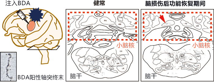 腦傷後可形成新的神經束，適當促進大腦變化可恢復運動功能