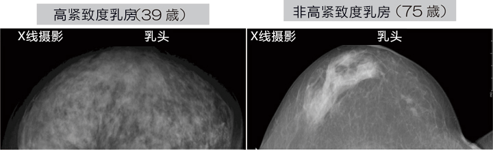 神戶大學開發成功新型微波乳房癌診斷儀