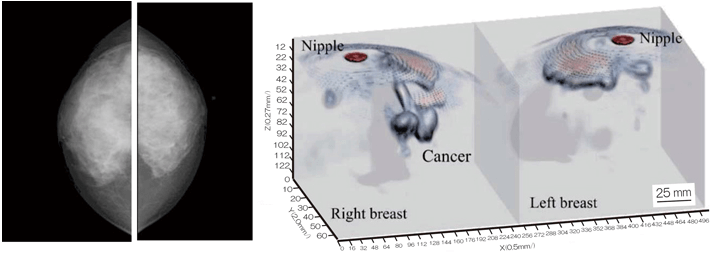 神戶大學開發成功新型微波乳房癌診斷儀